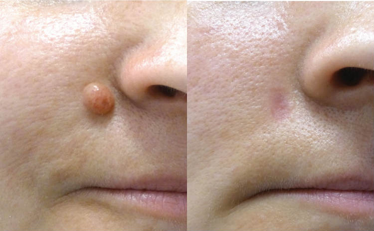 Skin Tag and Mole Removal - SkinCell Pro Reviews, Skin Tag and Mole Removal